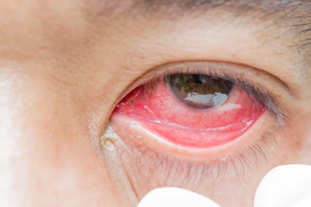 Can You Have a Contact Lens Allergy?