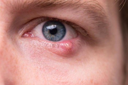 How To Get Rid of a Stye