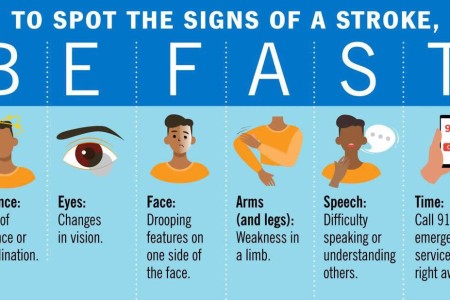 Signs of a Stroke: Act Quickly With ‘BE FAST’