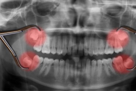Do Wisdom Teeth Have To Be Removed?