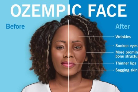 ‘Ozempic Face’: What It Is and How To Avoid It