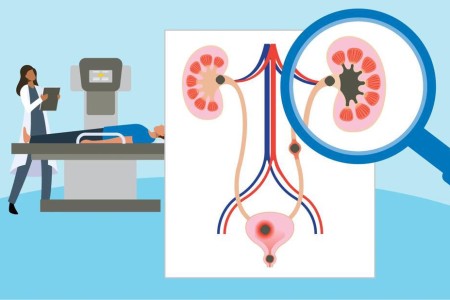 Can You Stop Kidney Stones From Forming?