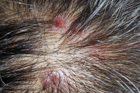 14 Reasons You Have Scabs on Your Scalp