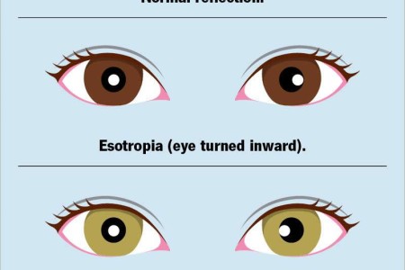 Corneal Light Reflex Test (Hirschberg Test)