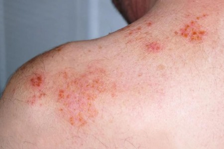 Recurrent Shingles: How It Happens and Who’s at Risk