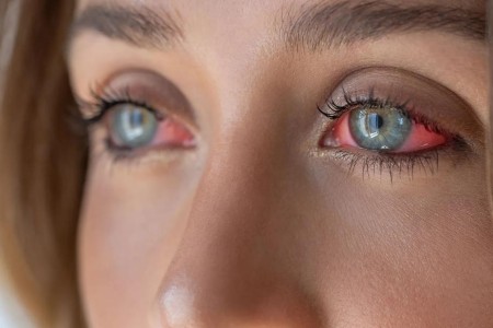 Think It’s Pink Eye? It Could Be One of These 11 Conditions Instead