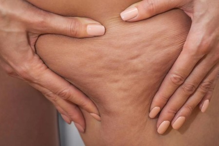 Can You Get Rid of Cellulite?