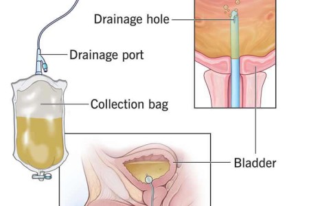 Urinary Catheter