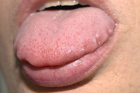 Scalloped Tongue