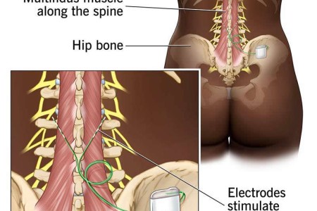 ReActiv8 (Restorative Neurostimulation)