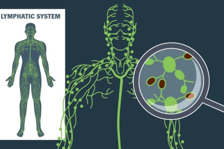 What Happens When Cancer Spreads to the Lymph Nodes?
