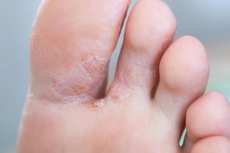Don’t Bother Using Home Remedies on Your Athlete’s Foot