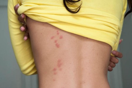 Are Those Bed Bug Bites? How To Tell