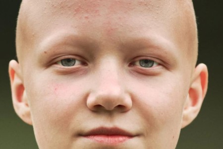 Managing Alopecia Areata Eyebrow and Eyelash Loss