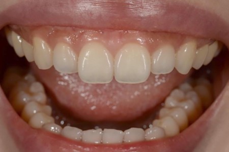 Translucent Teeth