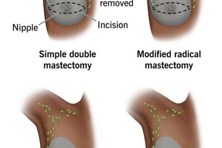 Double Mastectomy