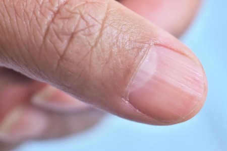 How Alopecia Areata Can Affect Your Nails