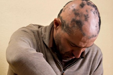 How Alopecia Areata Can Affect Your Mental Health