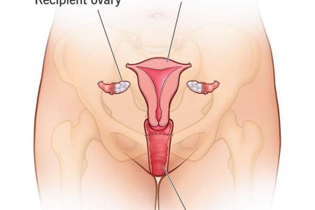 Uterus Transplant