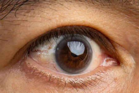 What’s the Difference Between Pinguecula and Pterygium?