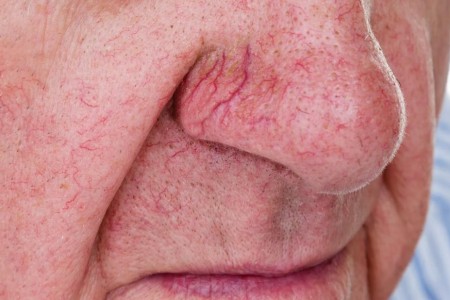 How Can I Get Rid of Spider Veins on My Face?