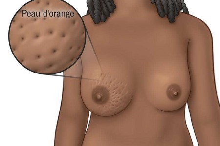 Breast Dimpling