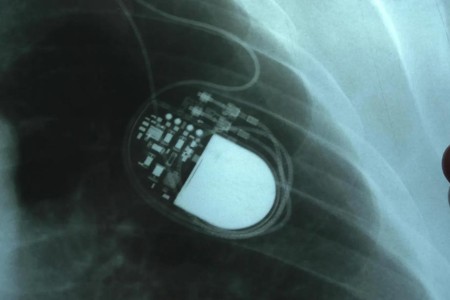 How To Know if You Need a Pacemaker
