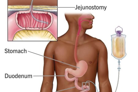J Tube Placement (Jejunostomy)