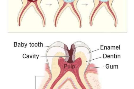 Pulpotomy