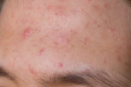 How To Avoid Sweat Pimples Year-Round