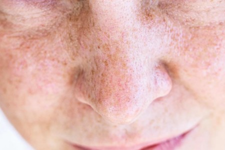 Congenital Adrenal Hyperplasia and Hyperpigmentation