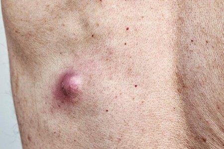 Should You Worry About the Lump Under Your Skin?
