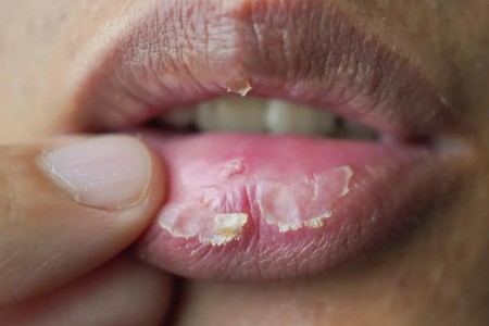 Yes, Even Your Lips Can Get Sunburned