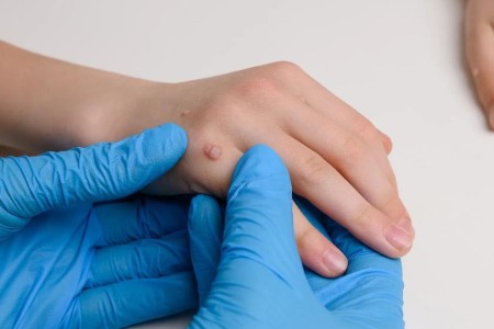 Childhood Warts: Why They Happen and What To Do