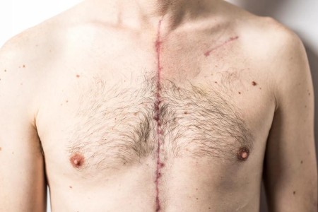 How To Care for Your Open-Heart Surgery Scar