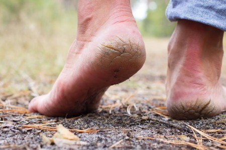 Cracked Heels? Here’s How To Heal Your Feet