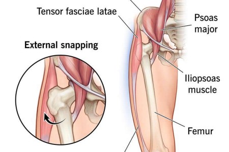 Snapping Hip Syndrome