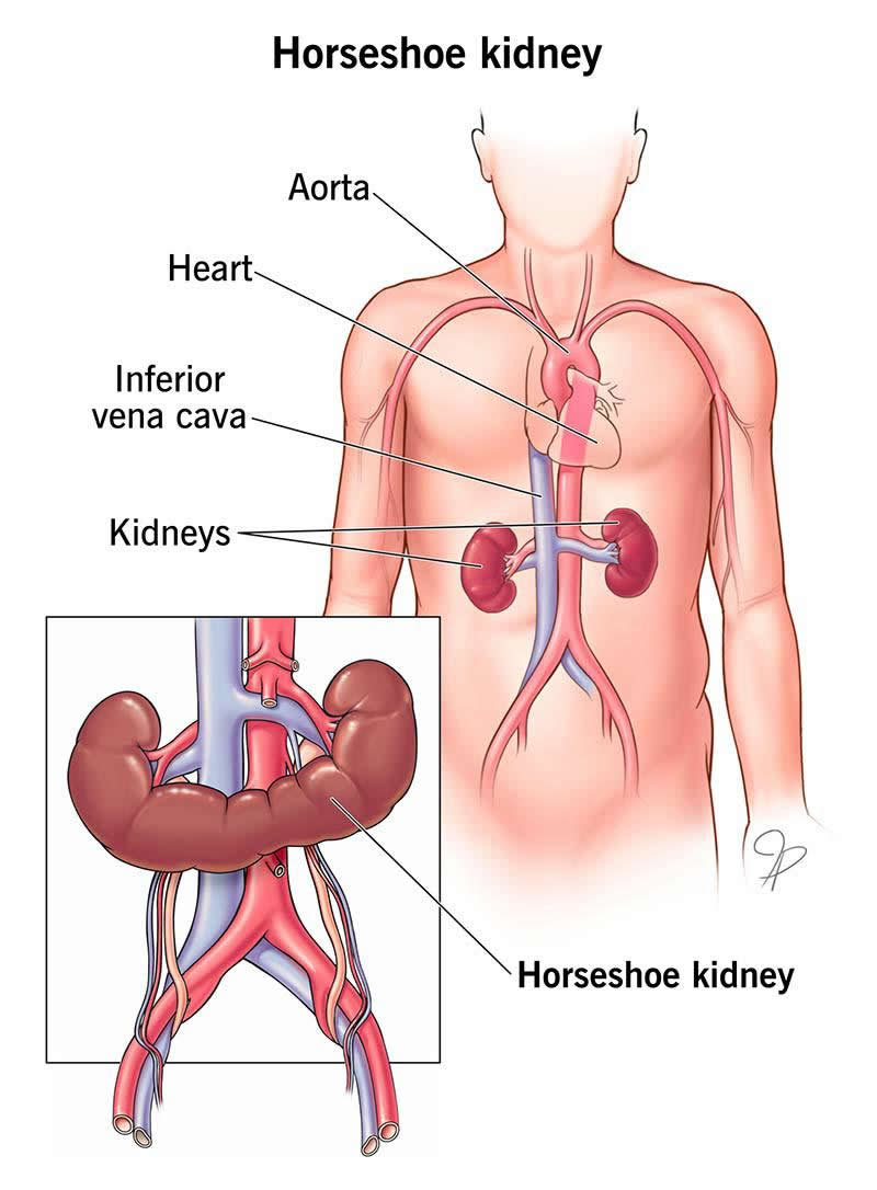 Horseshoe Kidney Renal Fusion Causes Treatment Wockr Horseshoe Kidney Renal Fusion Causes Treatment Wockr