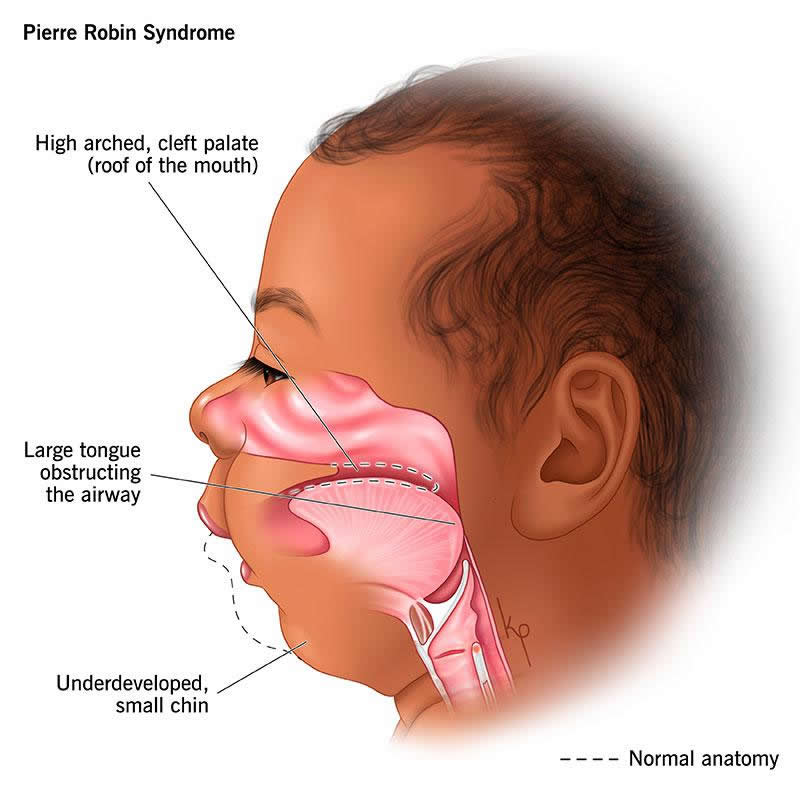 Pierre Robin Syndrome Sequence Wockr