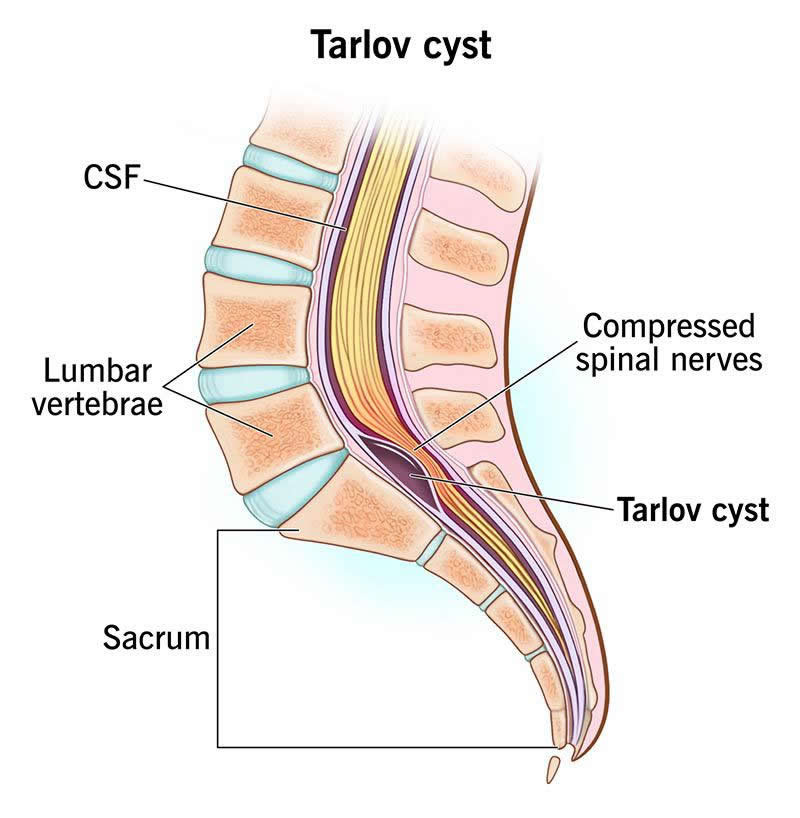 Tarlov Cyst: What It Is, Causes, Symptoms & Treatment - Wockr