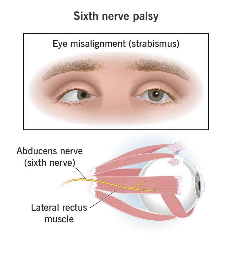 Sixth Nerve Palsy Causes Symptoms Treatment Wockr