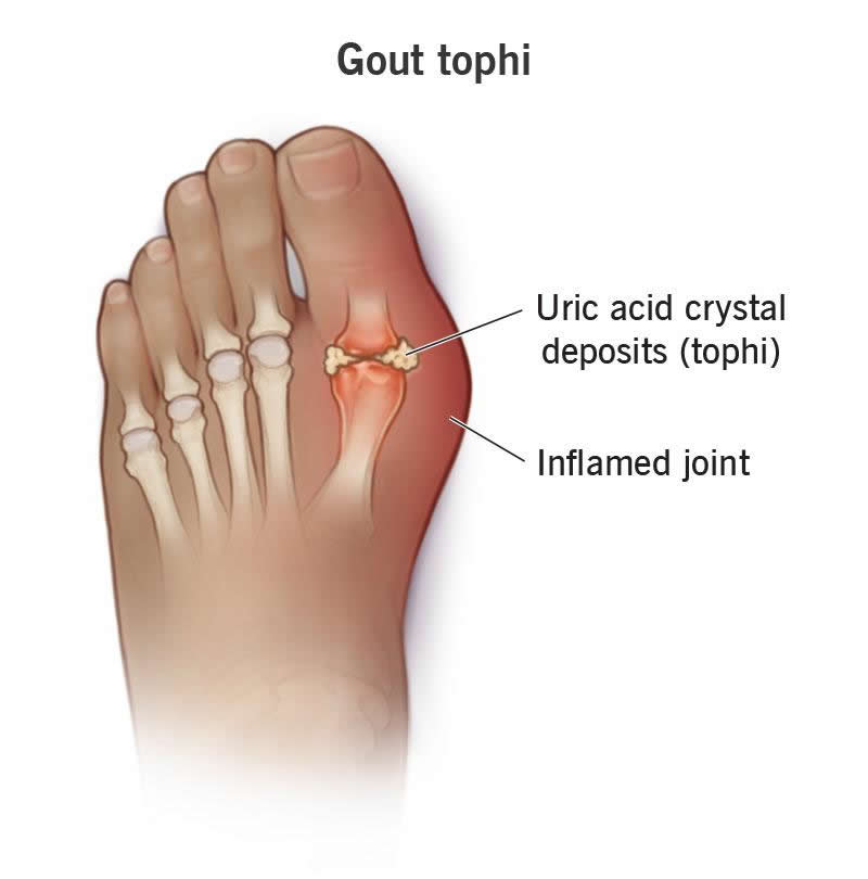 Gout Tophi Tophus What It Is Causes Treatment Removal Wockr